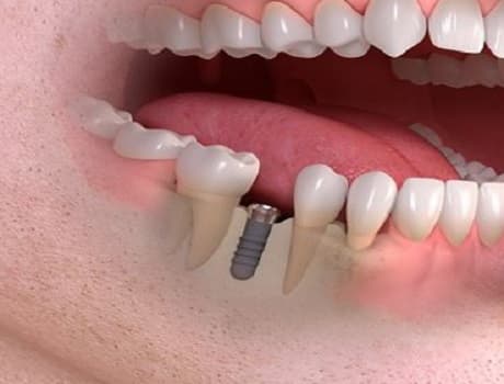 İmplant Sonrası Ağrı