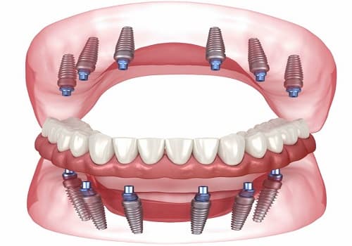 Tüm Ağız Diş Yaptırma Fiyatı