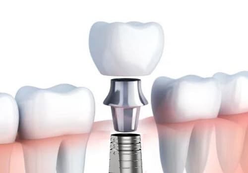 Vidasız İmplant Fiyatları