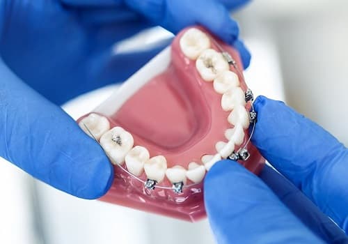 Yıllara Göre Diş Teli Fiyatları