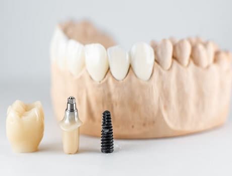 Zirkonyum Diş Fiyatları