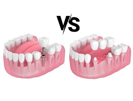 İmplant mı Köprü mü?