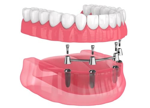 32 Diş İmplant Fiyatları