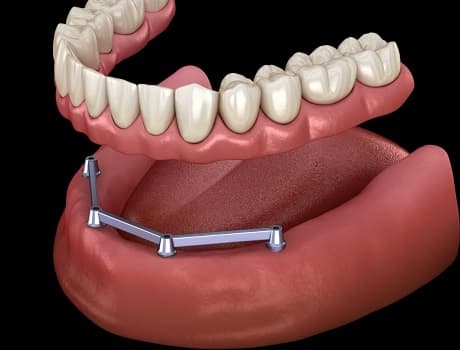İmplant Vidası Takıldıktan Sonra Diş Ne Zaman Takılır?