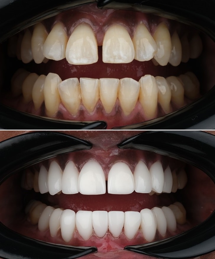 all-on-4-implants-borris-1.webp