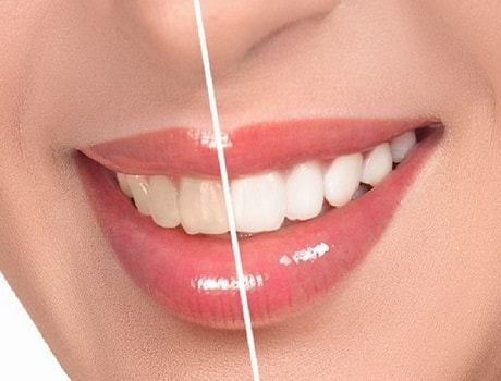 all-on-4-before-after-borris-3.webp