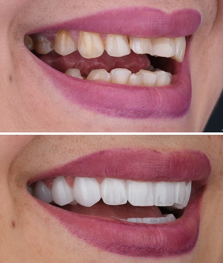 all-on-4-before-after-borris-4.webp
