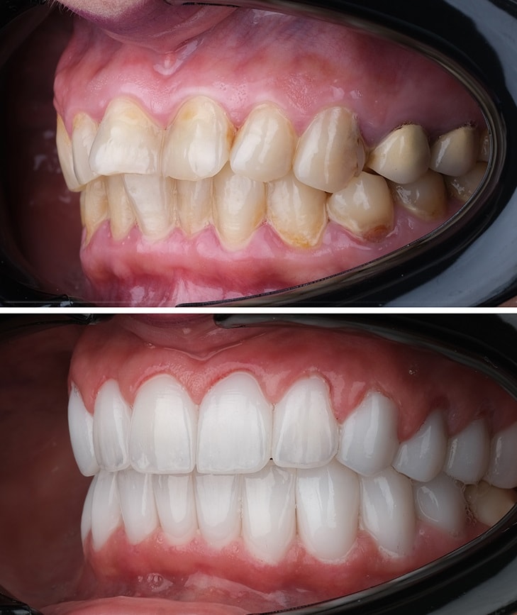 all-on-4-before-after-borris-3.webp