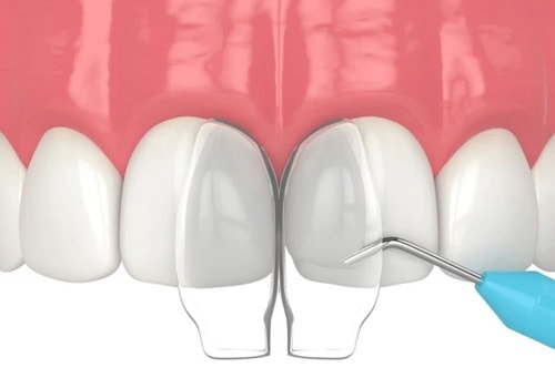 all-on-4-implants-borris-1.webp
